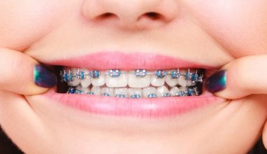 HOW MUCH DOES BRACES COST