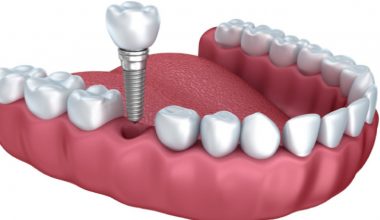 Custo do implante dentário